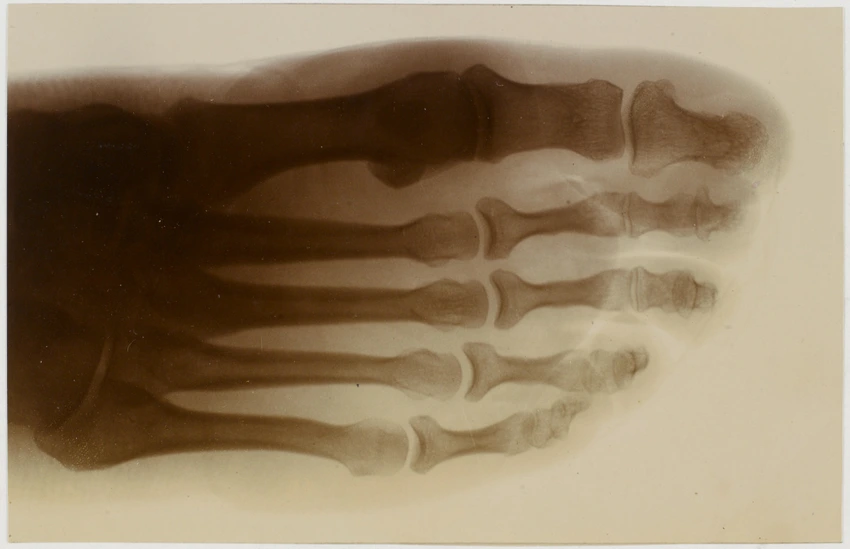 Albert Londe - Radiographie négative d'un pied chaussé