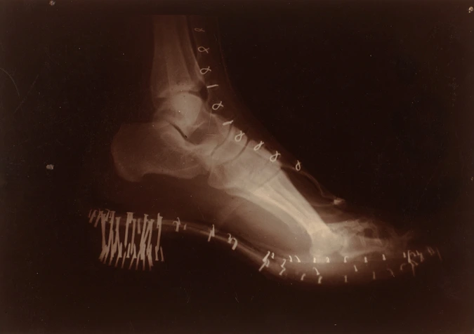 Albert Londe - Radiographie négative d'un pied