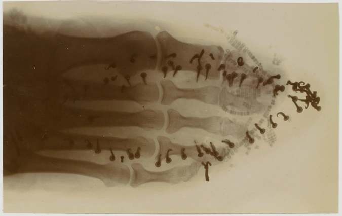 Albert Londe - Radiographie positive d'un pied chaussé