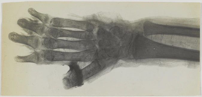 Albert Londe - Radiographie négative d'une main de momie