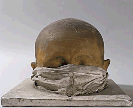 Anonyme, France-Moulage d'un crâne présentant une perte de la substance occipitale